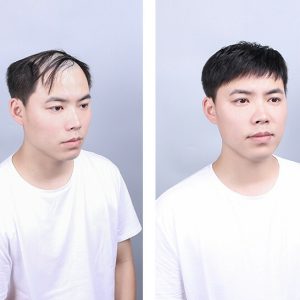 Men's Hair Replacement Forehead Bald Flip Cover